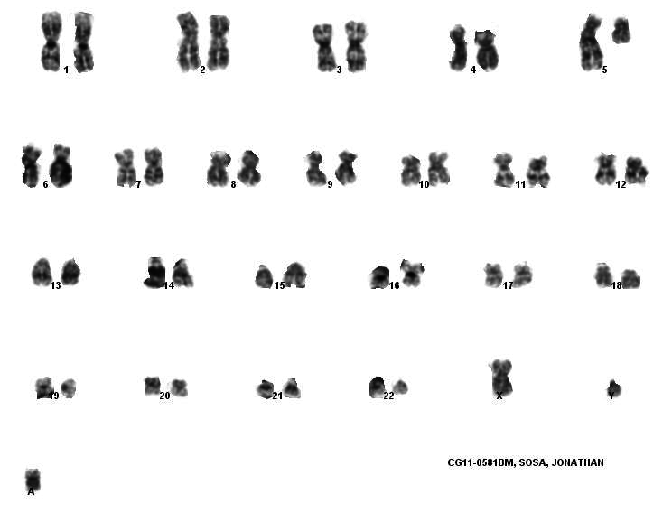 Conventional cytogenetics showing abnormal karyotype: 47,XY,add(5)(q31),del(5)(q13q33),+mar